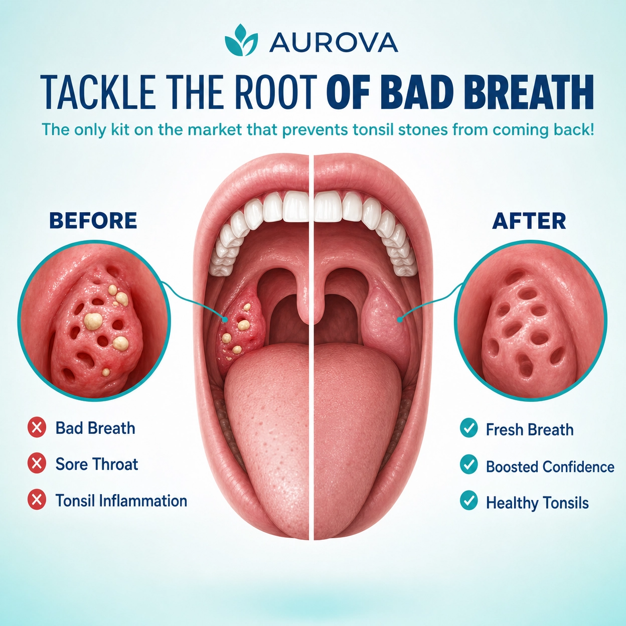 Aurova Pro™ | HD Visual Tonsil Stone Remover